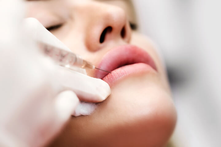 woman receiving a dermal filler injection in her lip 