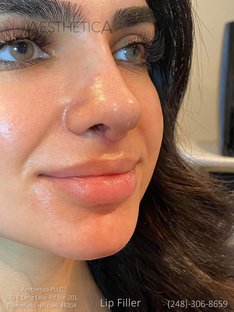 A woman who had lip filler treatment in a beauty clinic.